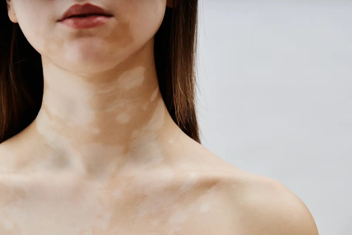 Dermatology