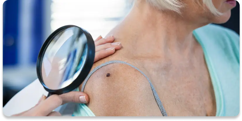 Skin Cancer and Melanoma